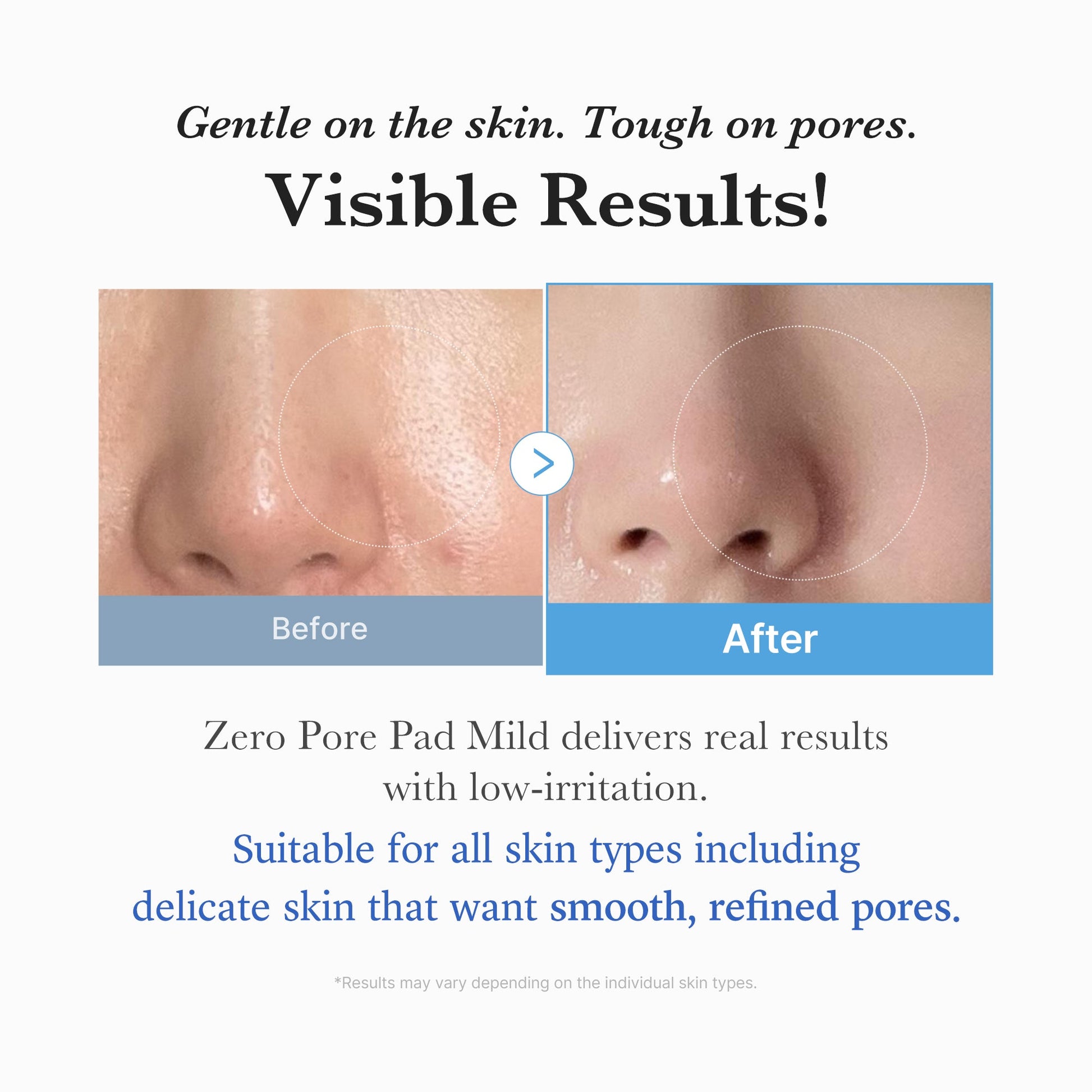 zero-pore-madecassoside-pads-mild-d0 04_6357f9f9-483b-4891-82c6-a58d336e62c8.jpg